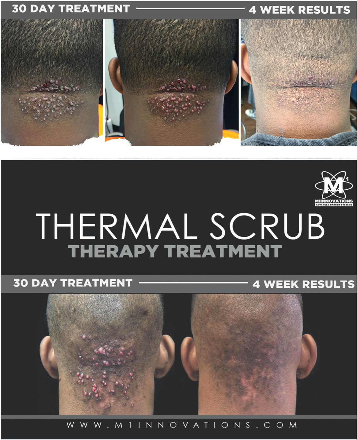 LEARN: Keloidalis Nuchae Therapy Treatment Professional Service
